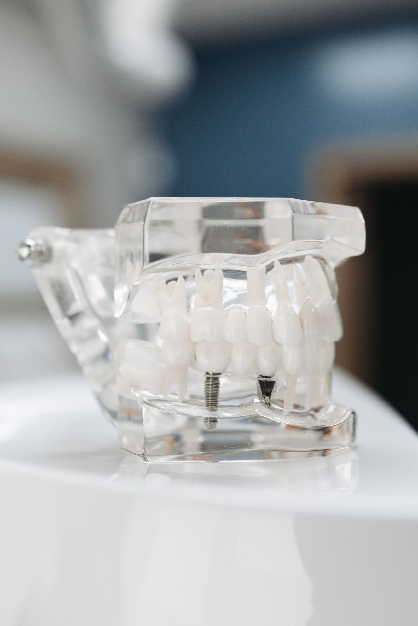 Modelo transparente de implantes dentales